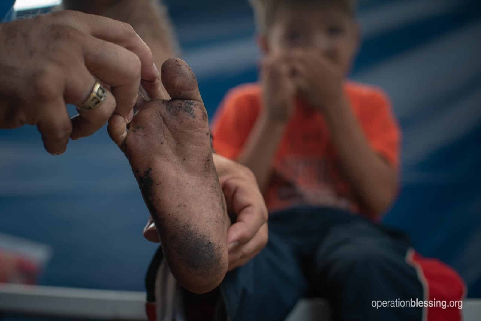 The dirty injured foot of a young Venezuelan refugee.