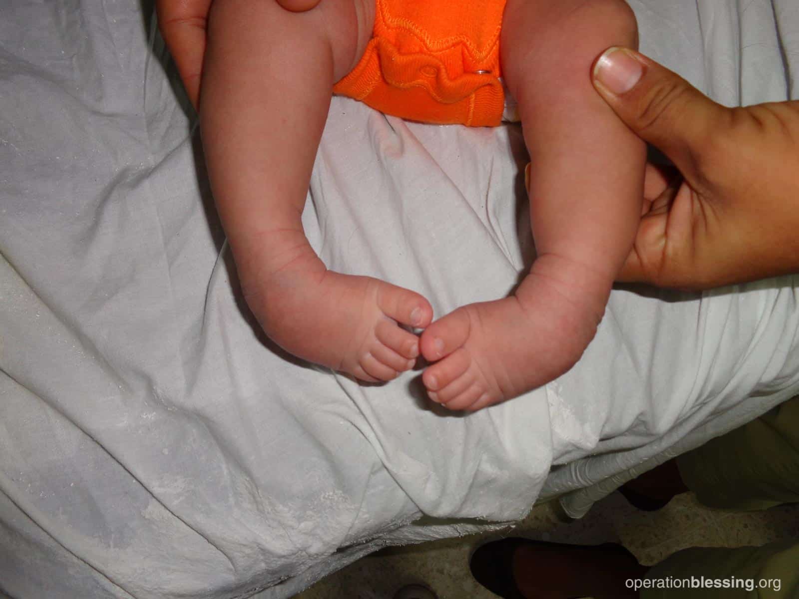 Free Clubfoot Treatment for Baby in Need - Operation Blessing