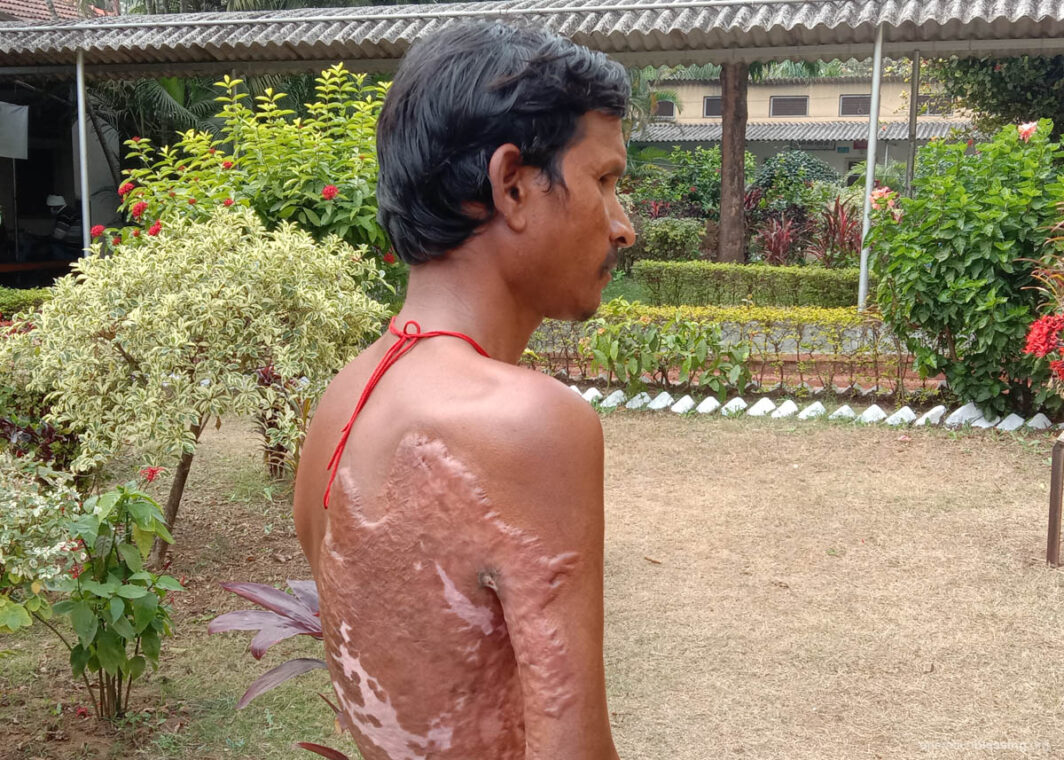 crowdfunded-burn-scar-surgery