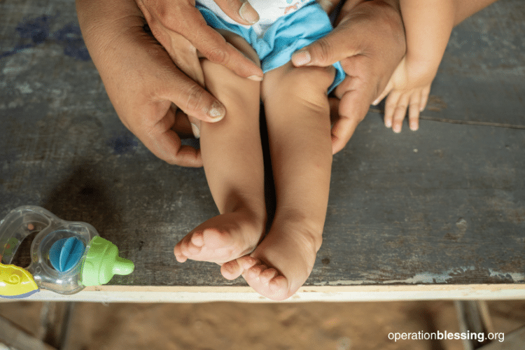 successful life changing foot surgery for child in peru