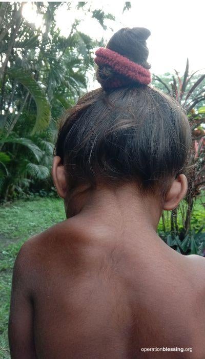 indian child recieves surgery for shoulder deformity