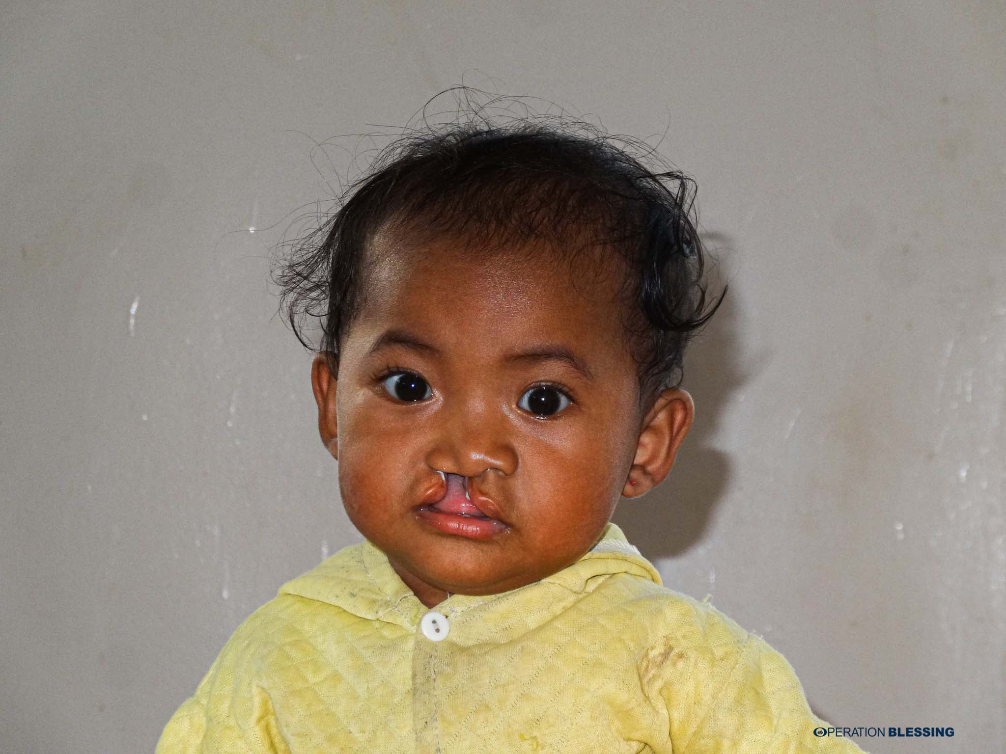 cleft-lip-surgery-cambodia-before