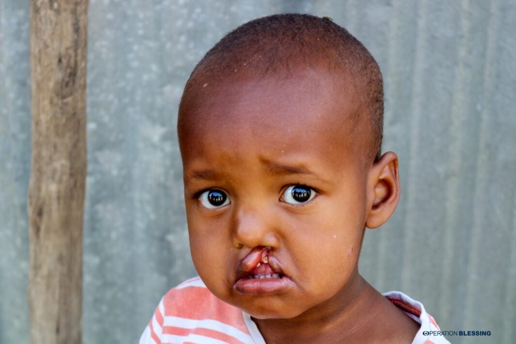 cleft lip and palate surgery