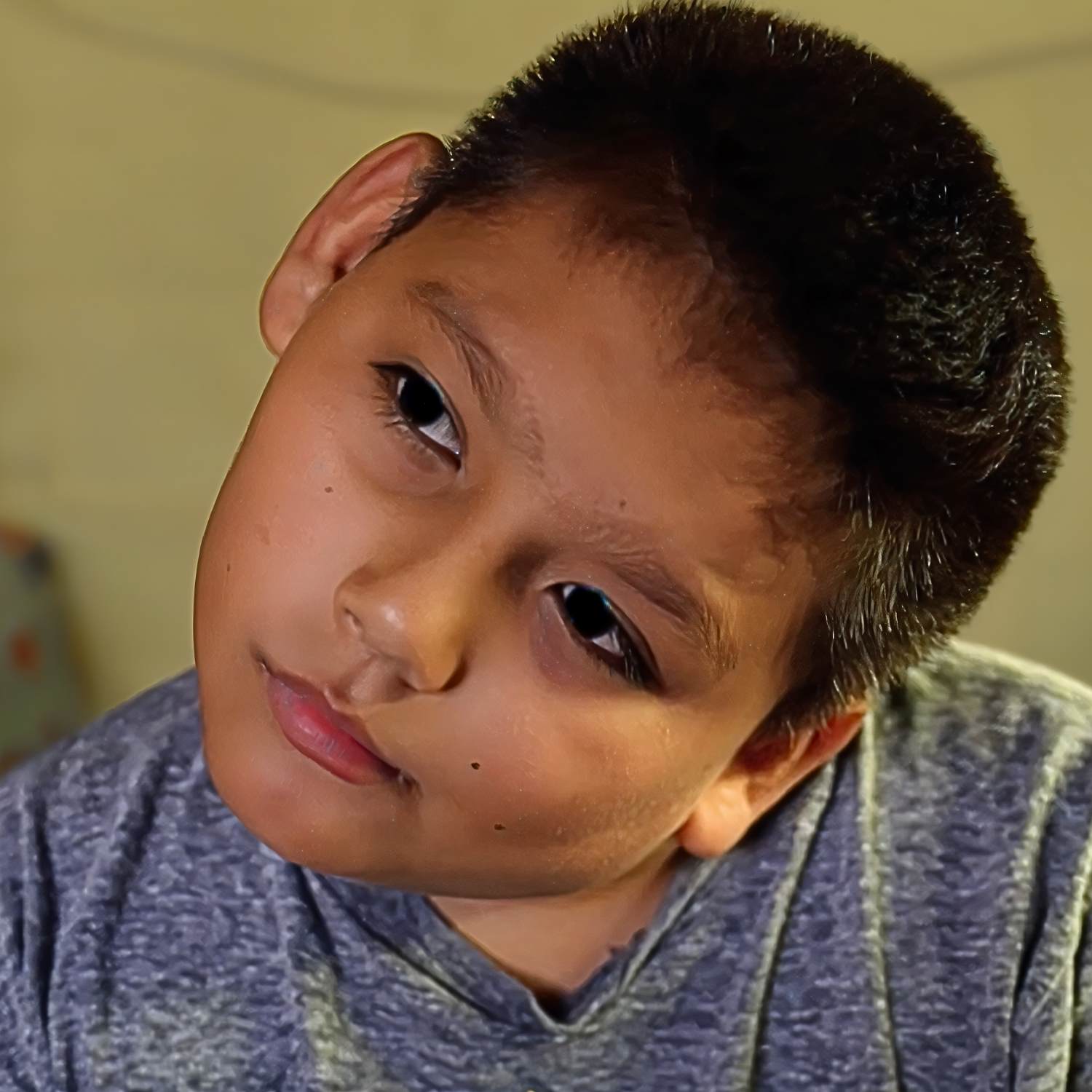 life changing Torticollis surgery